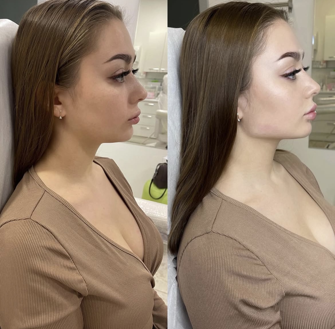 Коррекция углов нижней челюсти